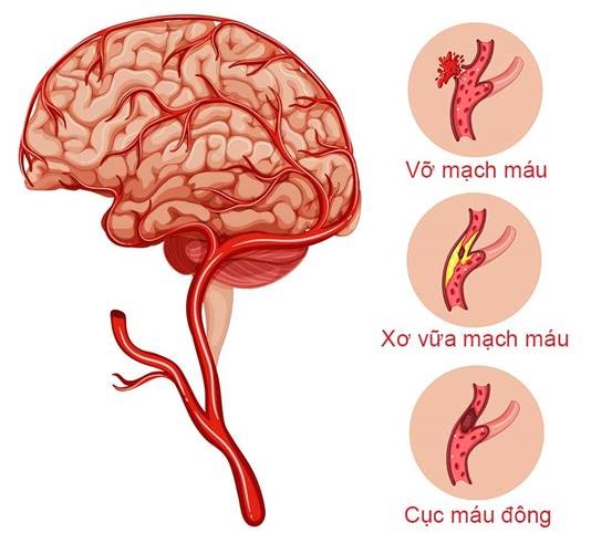 Đột quỵ là một căn bệnh nguy hiểm có xu hướng trẻ hóa. Do đó, việc ngăn ngừa đột quỵ từ sớm là cần thiết 